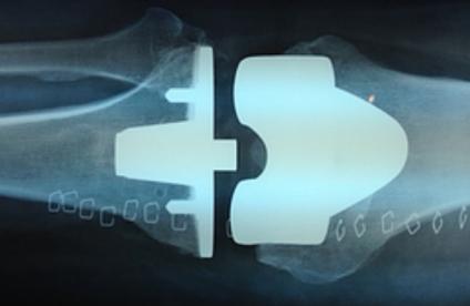 Prothèse du genou avec implant tibial en titane
